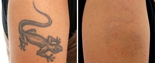 ... Tattoo Removal Cost, Best in Sydney | Cosmetic Medical Clinic Sydney