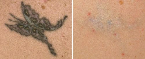 Price Check: Cost For Laser Tattoo Removal Treatment, Best in Sydney ...