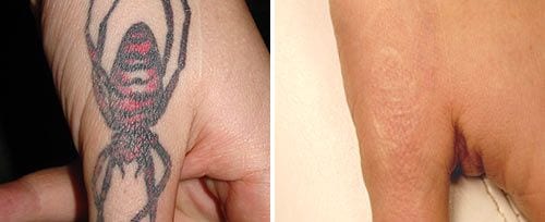 ... Laser Tattoo Removal Cost, Best in Sydney | Cosmetic Medical Clinic
