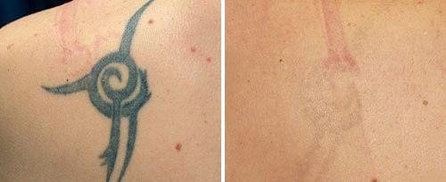 Price Check: Cost For Laser Tattoo Removal Treatment, Best in Sydney ...